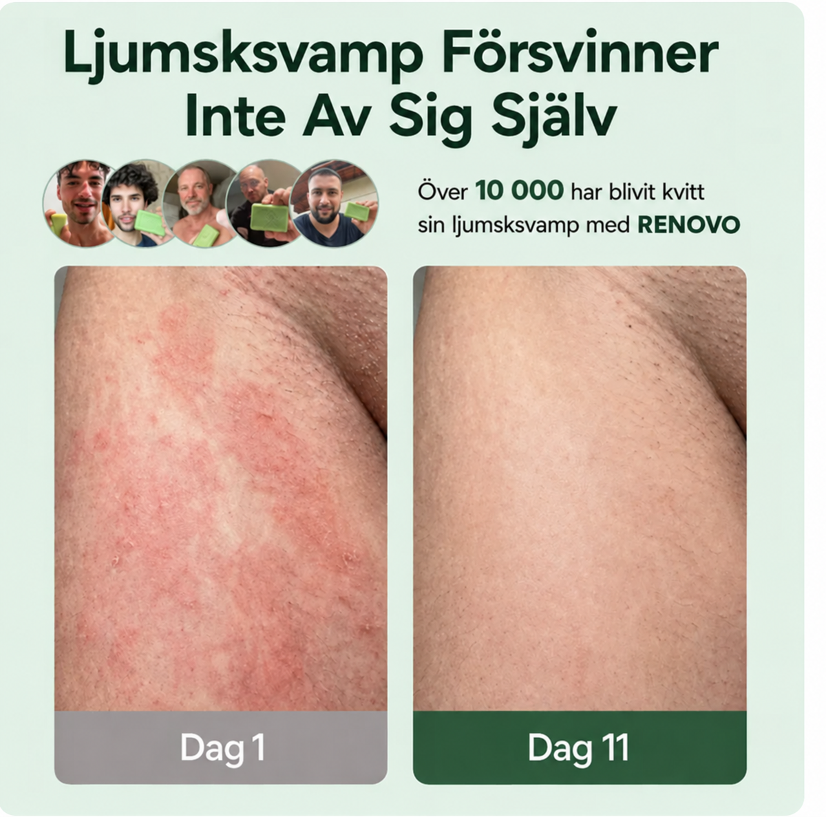 Renovo™ - Slipp fotsvamp som alltid kommer tillbaka