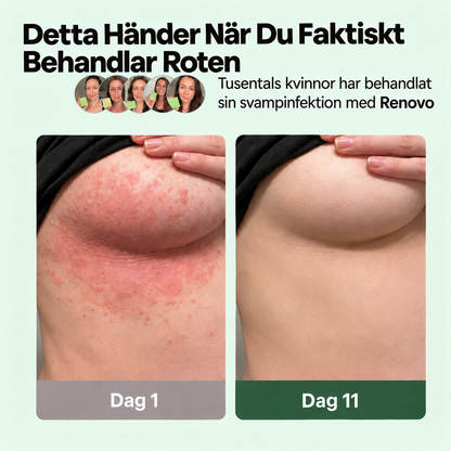 Renovo™ - Slipp fotsvamp som alltid kommer tillbaka